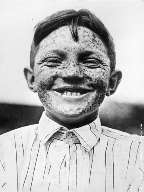 1940: Jack Hexberg, from Portland, the Freckle King of Oregon