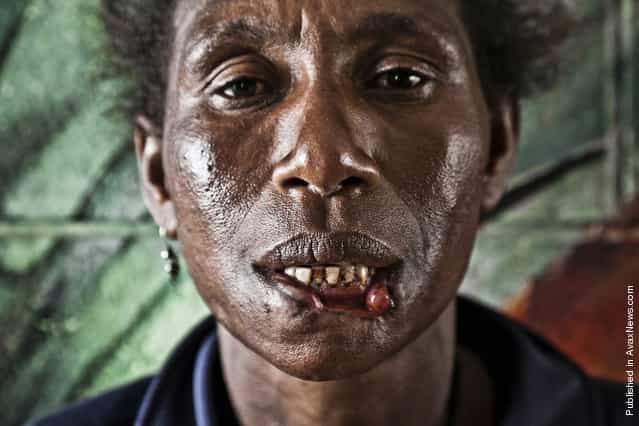 Helena Michael (40), mother of seven children. On December 27th (2011) she was attacked by a [cannibal] near the Boroko police station, in the central part of Port Moresby. The attacker bit off Helenas lower lip and wanted to sink his teeth into her throat. The woman managed to escape by kicking her assailant in his testicles and biting three of his fingers forcing him to release her. Police arrested the man and found out that it was his third attempt to eat human flesh. Having spent three days in the hospital, Helena went to the police station to initiate criminal proceedings against the cannibal, but discovered that he had been released due to the lack of complaints. Helena is still waiting for the hospitals approval to start surgery for skin graft on her missing lip