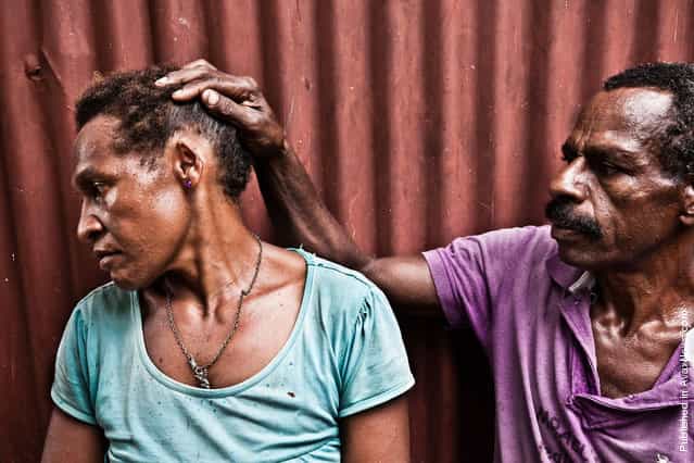 Richard Bal (45) shows disfigured ear of his wife Agita Bal (32) in the Morobe block, Port Moresby. In December of 2010 after coming home drunk, Richard took a bush-knife and cut half of Agita’s left ear. He spend one night in the police station and was released next morning due to [insufficient evidence] to initiate criminal proceedings. Agita’s relatives didn’t allow her to leave Richard, having received 500 kina (about 240 USD) from him for the [potential damage]