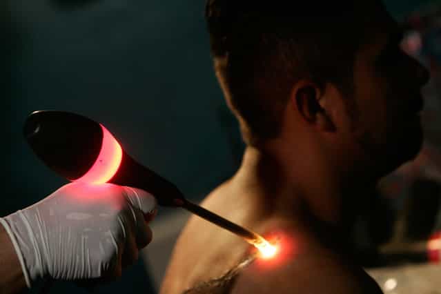 A former gang member has a tattoo characteristic of the Mara Salvatrucha street gang erased with an infrared ray, which burns the top layer of skin off, at a clinic in Chamelecon, in San Pedro Sula, Honduras, on January 28, 2008. Former gang members and other people with tattoos go through the painful process of having the tattoos removed to improve their chances of employment or to make them less easy to be identified as illegal migrants in the U.S. The gang members in the tattoo removal clinic say active gang members who have their tattoos removed are sometimes murdered by other gang members. (Photo by Edgard Garrido/Reuters)