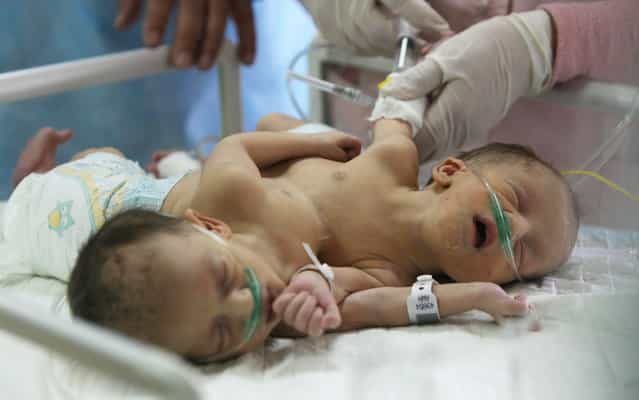 Three-day-old Iman and Amani Palestinian Siamese twin girls from the Breiwesh family lie on a bed in the newborns unit at the Alia Hospital in the West Bank city of Hebron on June 03, 2013. Their mother received permission from the Israeli government to deliver at Jerusalem’s Hadassah Hospital, but the girls were born with one stomach and two hearts connected in one organ, according to Israeli doctors. The woman was warned by Palestinian doctors during prenatal checkups that she had Siamese twins but she refused to terminate her pregnancy because of her religious beliefs. (Photo by Hazem Bader/AFP Photo)