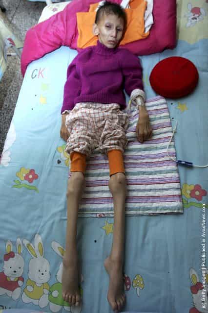 12-year-old Chinese girl Sun Yangyang suffering from Cockayne syndrome