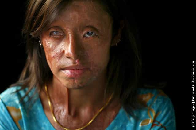 Saira Liaqat, 22, a victim of acid violence who was burned 4 years ago